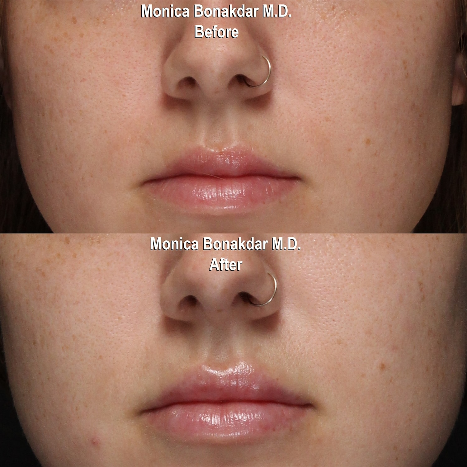 Before and after facial treatment comparison.
