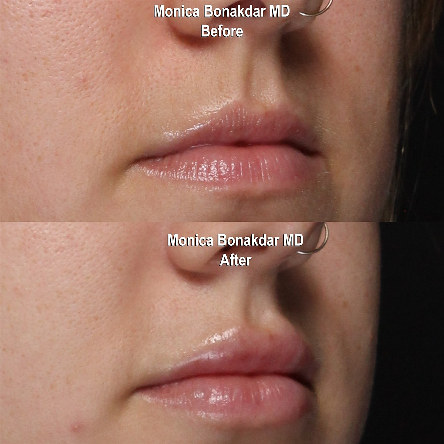Before and after lip enhancement procedure comparison.