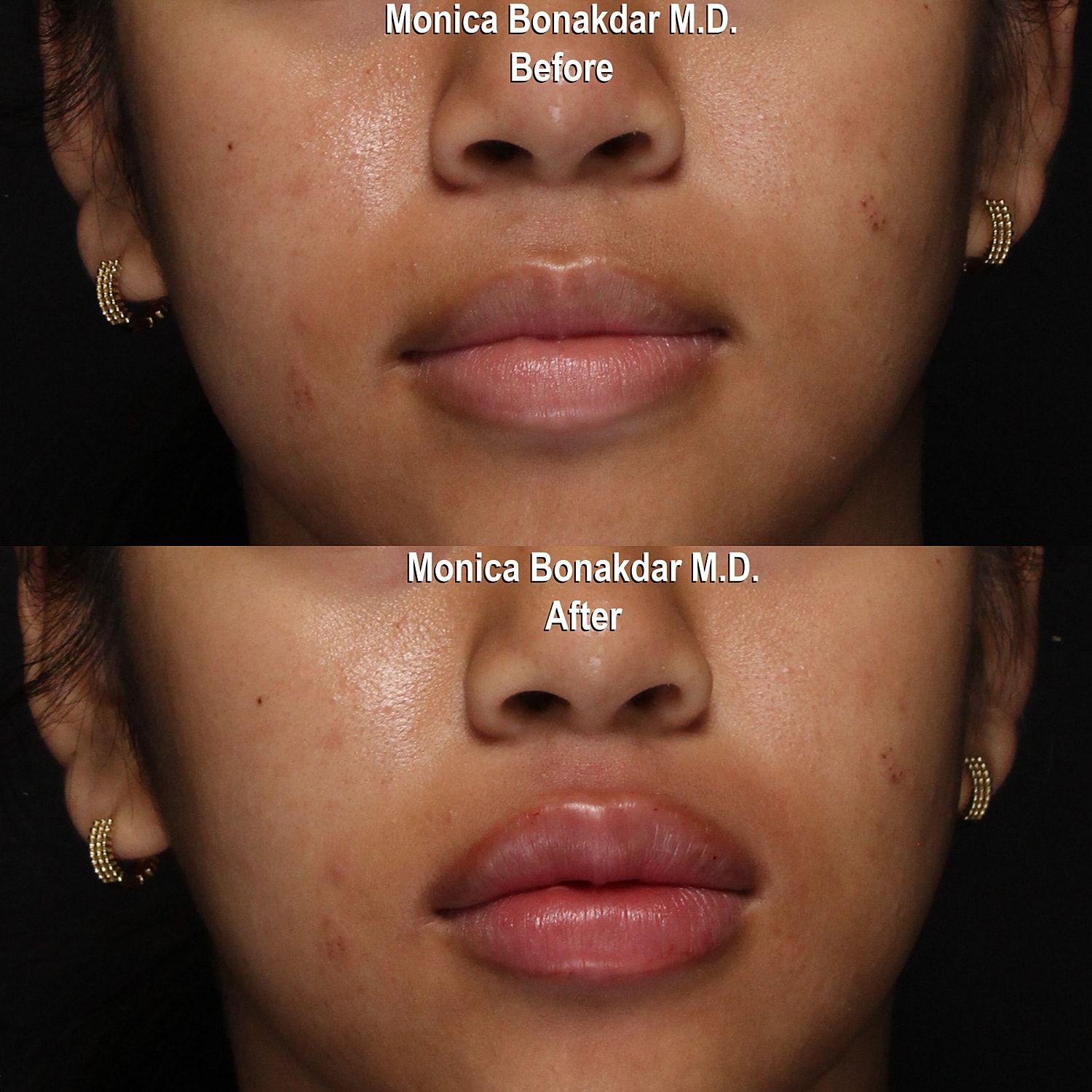 Before and after lip enhancement results.