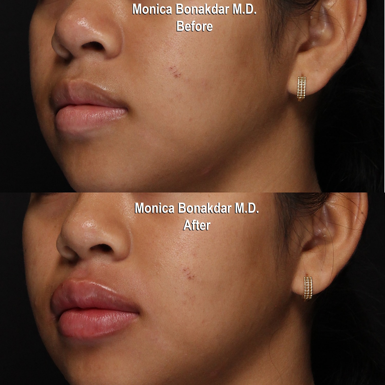 Before and after skin treatment comparison image.