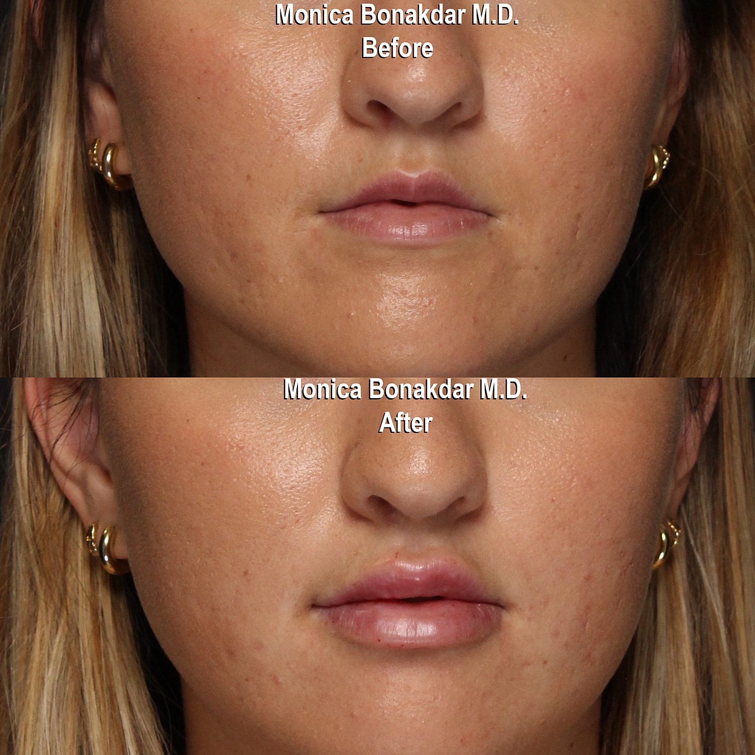 Before and after cosmetic treatment comparison image.