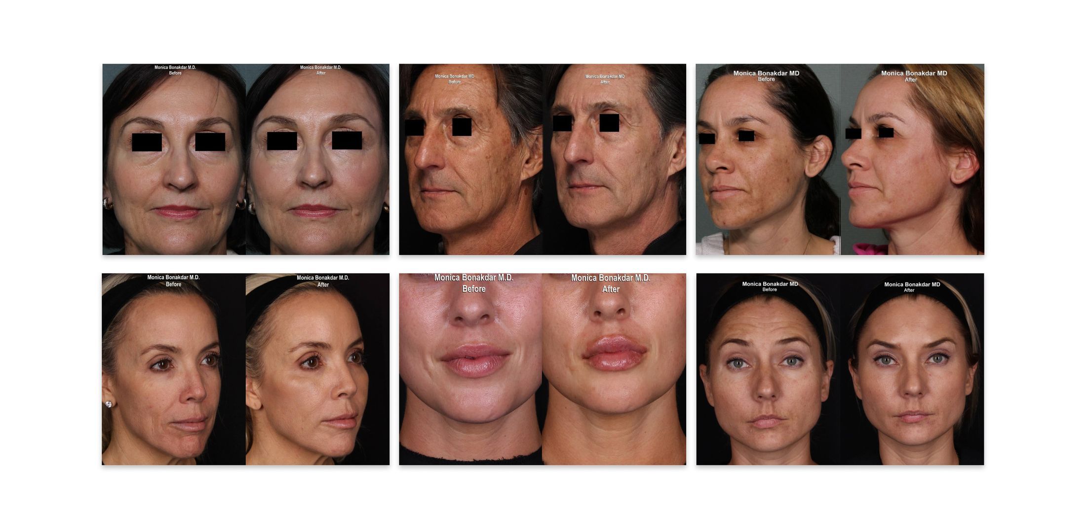 Aesthetix Lab Before and Afters in Dana Point